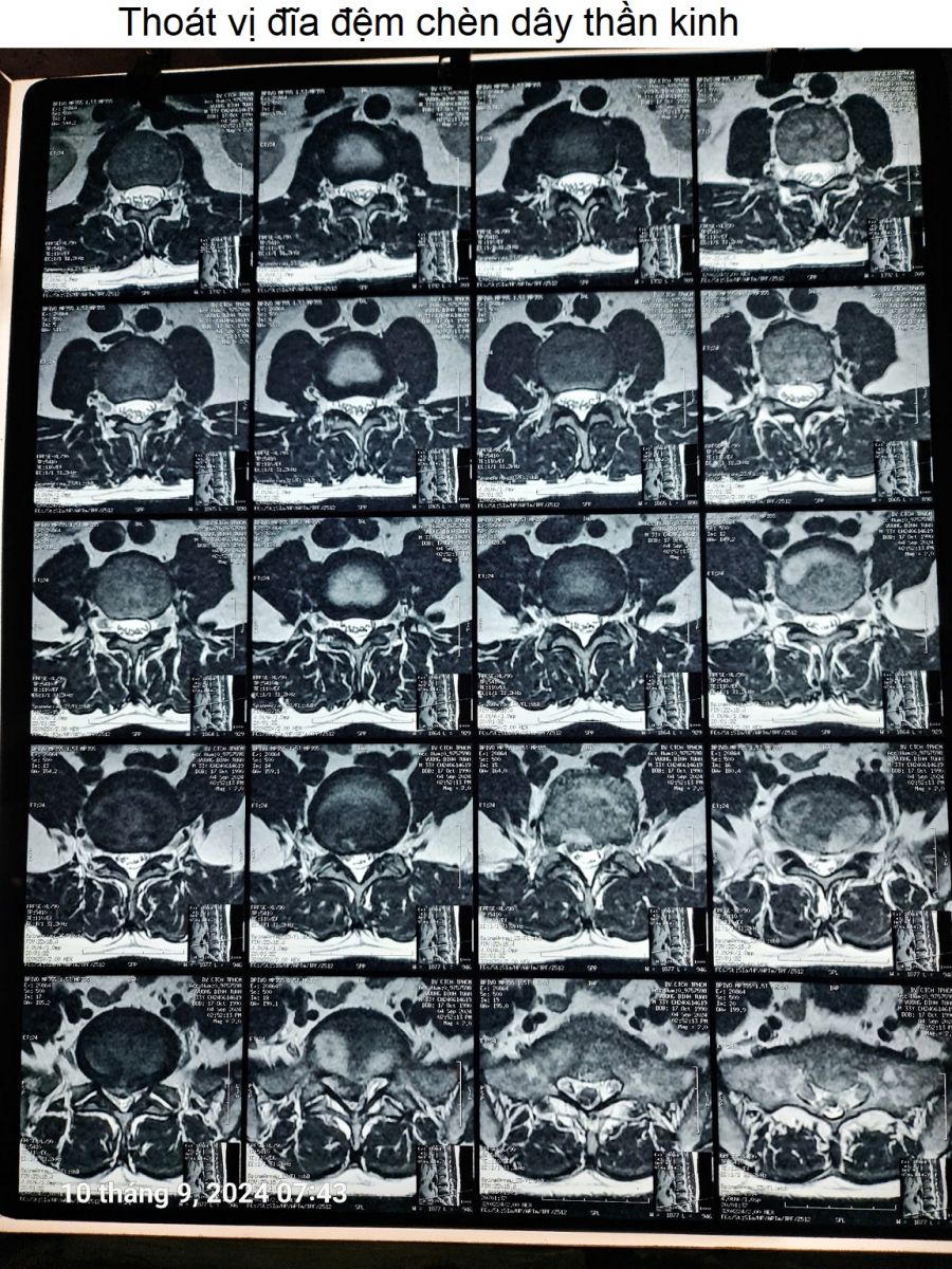 Thoat-vi-dia-dem-chen-day-than-kinh